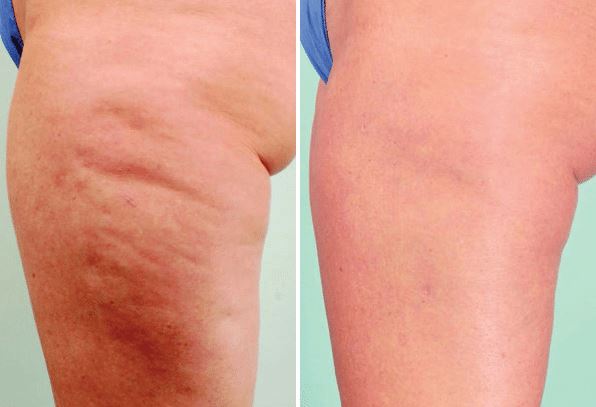 cellulite treatment 1 new jersey