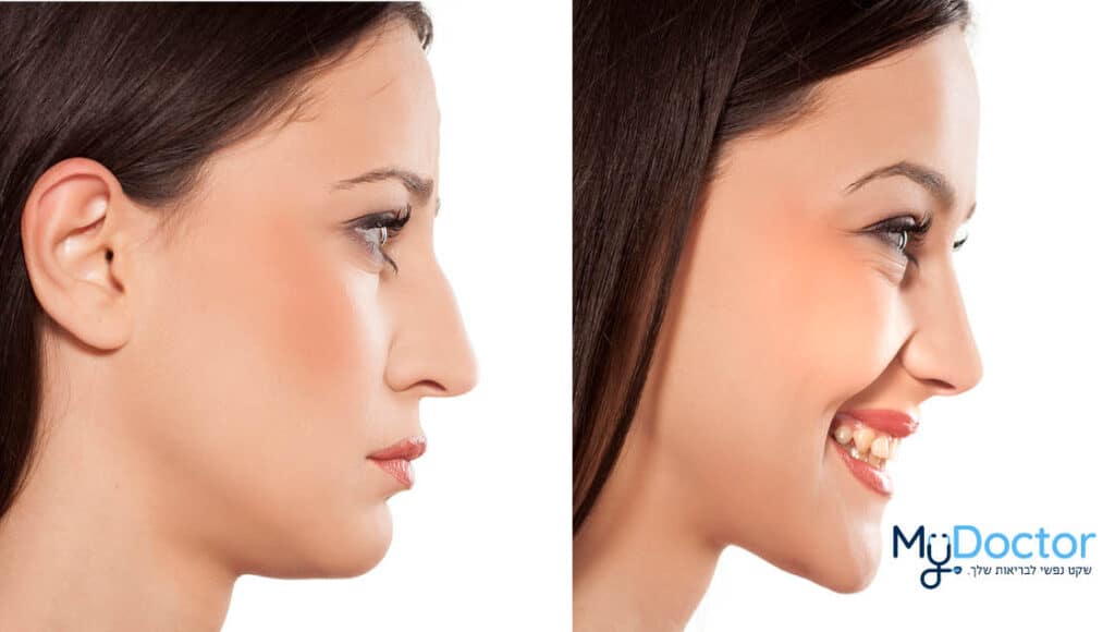 injections-nose-av - MyDoctor