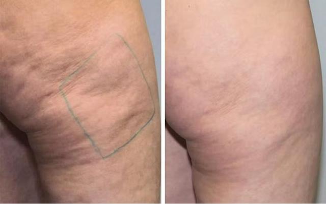 1612205844 cellulite treatment nyc before after photos 2 Copy