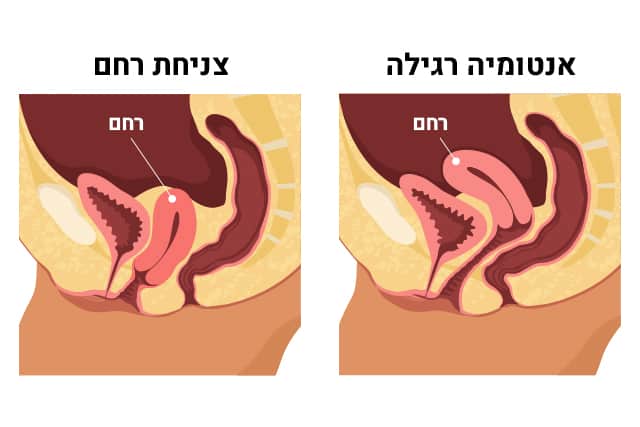 צניחת רחם 15 צניחת רחם תמונה